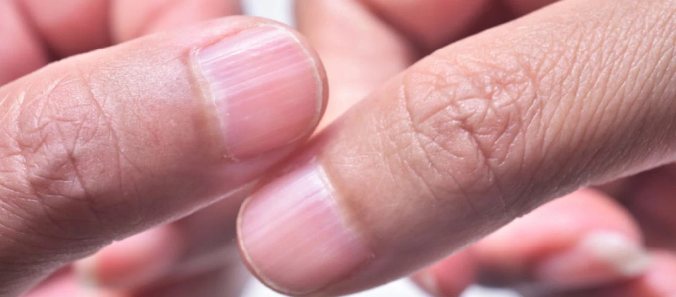 Προσοχή: To σημάδι στα νύχια που δείχνει ότι πρέπει να ελέγξετε τον θυροειδή σας